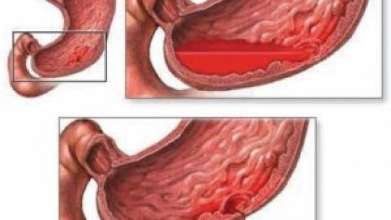 Ulcer